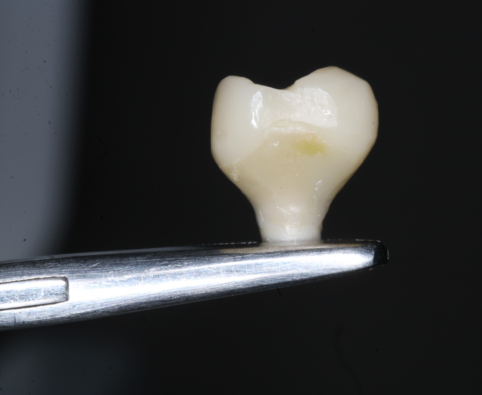 Implantes Dentales